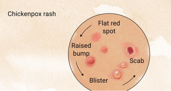 水痘进入高发时期,专家提醒:及时接种疫苗.png 水痘进入高发时期,专家提醒:及时接种疫苗.png